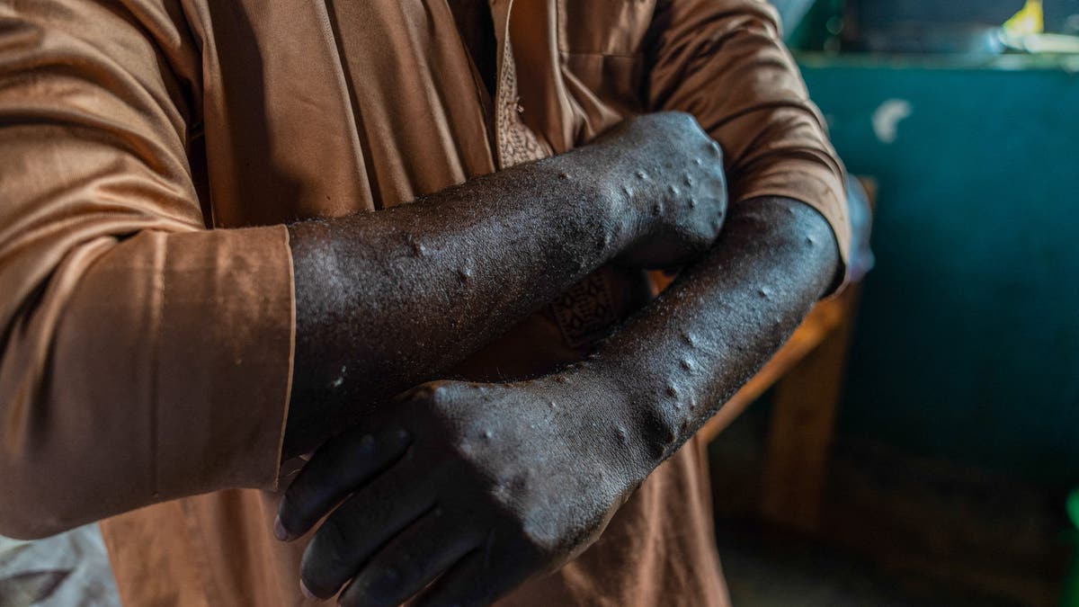 Arms of patient with monkeypox